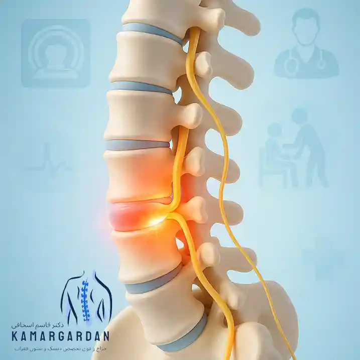 آیا پارگی دیسک کمر ترمیم می‌شود؟