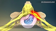 پارگی دیسک کمر و روش های درمان